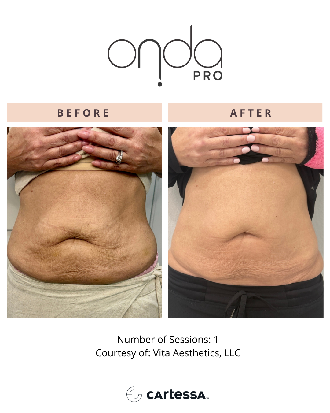 ONDA PRO abdomen before and after