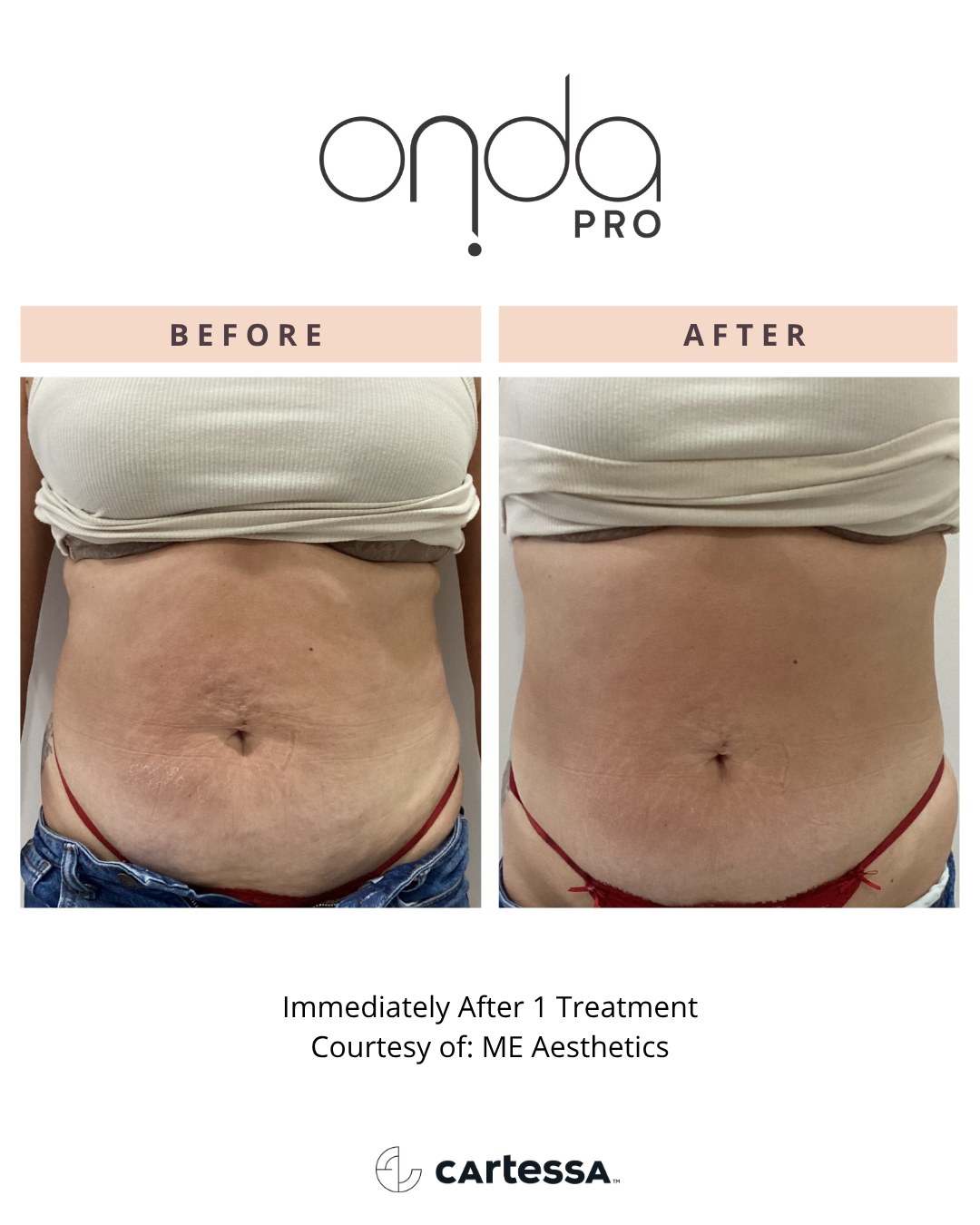 ONDA PRO abdomen before and after