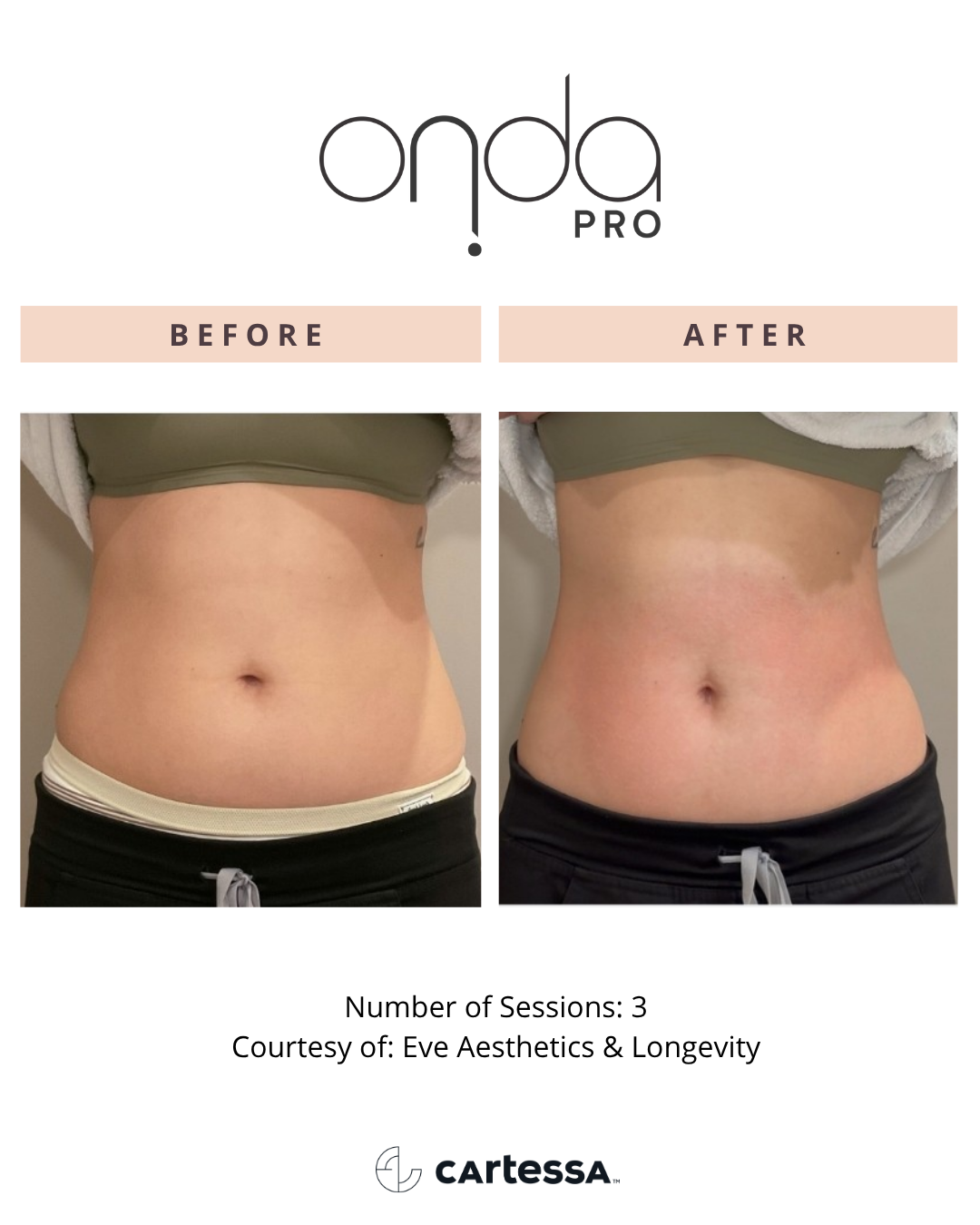 ONDA PRO abdomen before and after