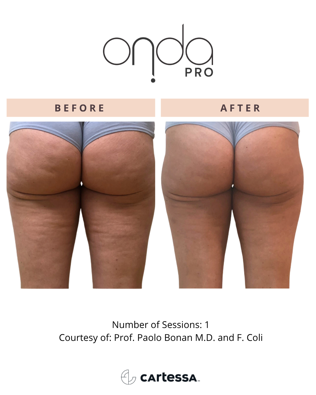 ONDA PRO glute before and after