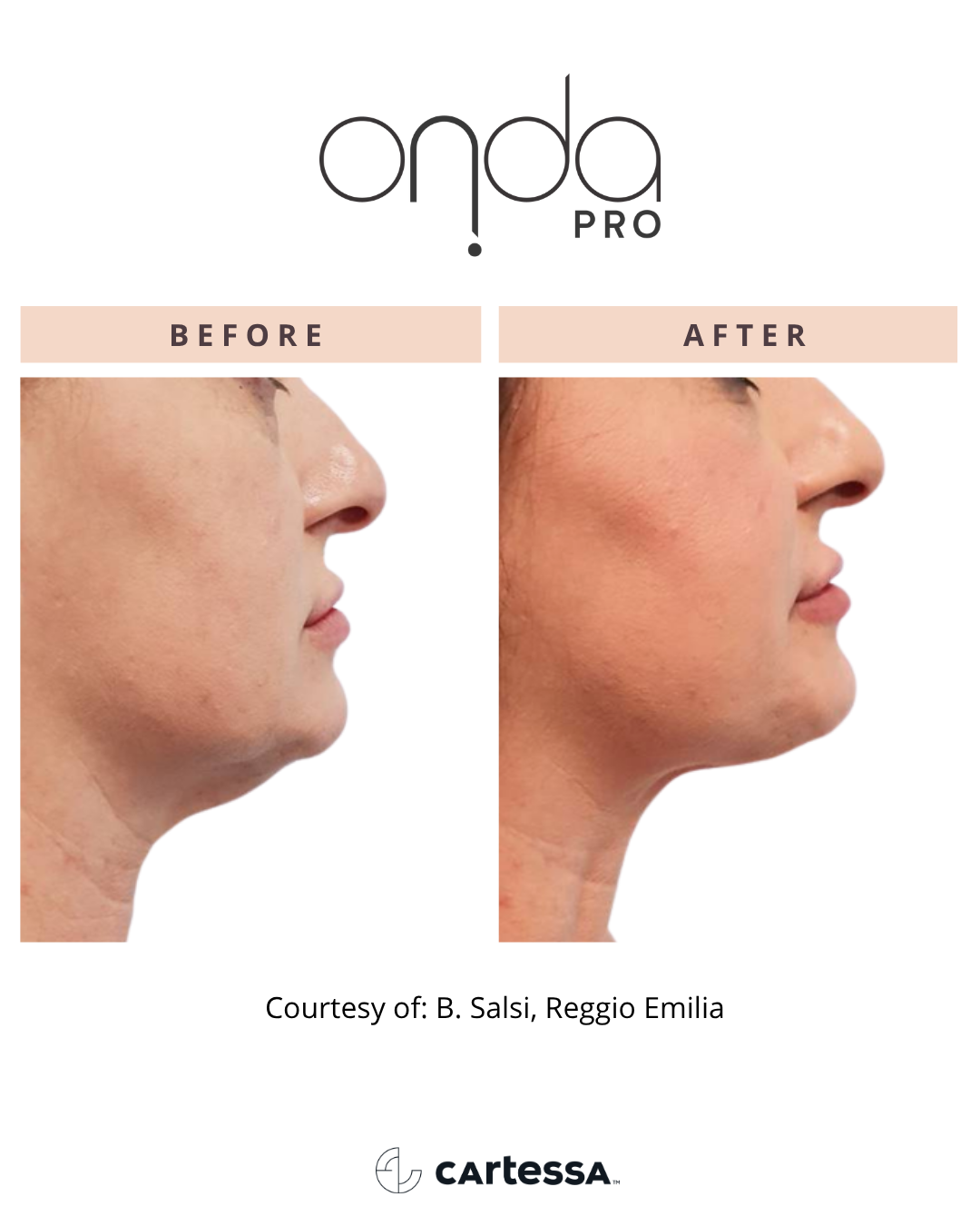 ONDA PRO chin before and after