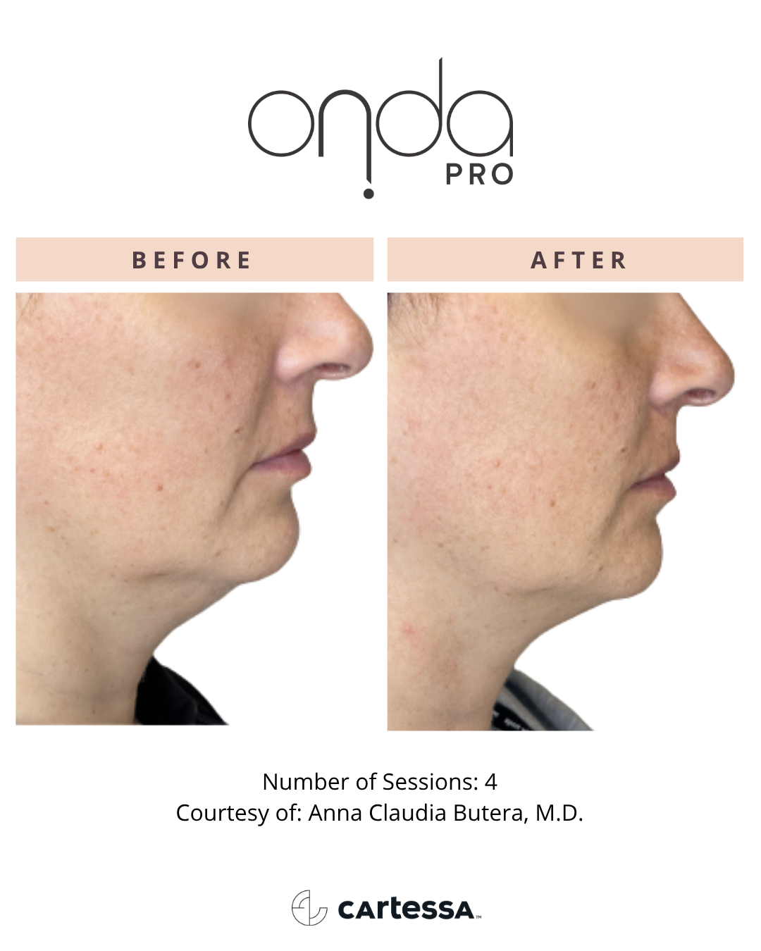ONDA PRO chin before and after