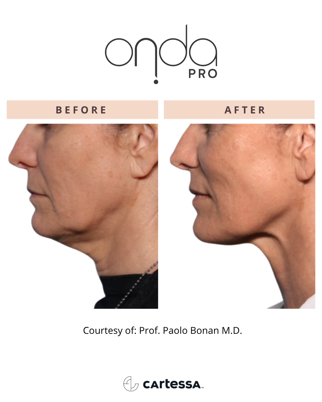 ONDA PRO chin before and after