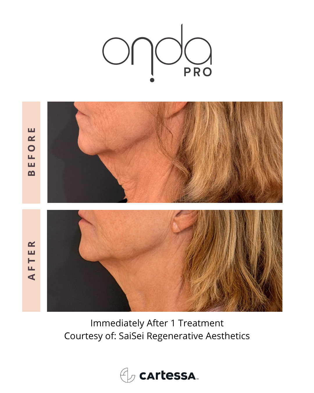 ONDA PRO chin before and after