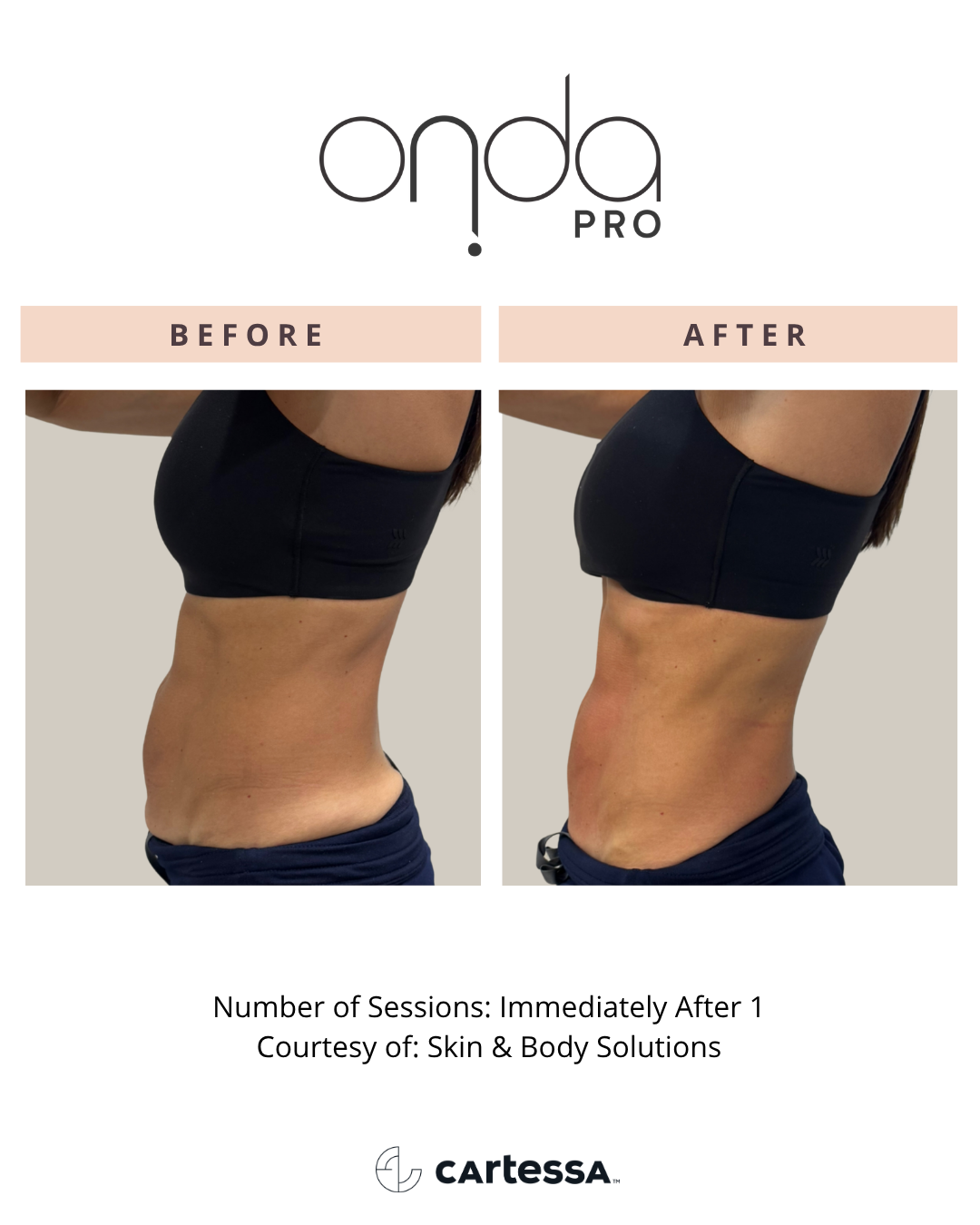ONDA PRO torso before and after