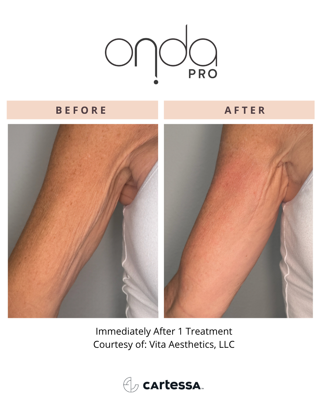 ONDA PRO underarm before and after